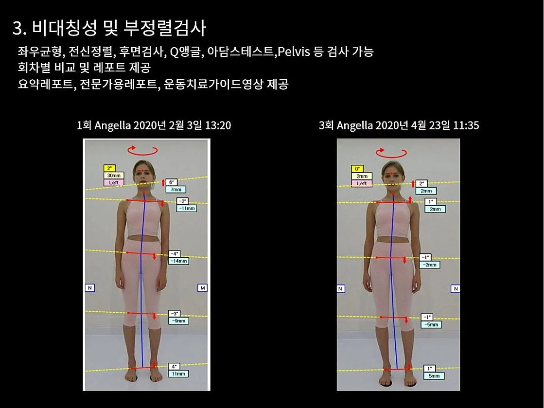 엑스바디 실손 삭감 예방 비대칭 부정렬 검사